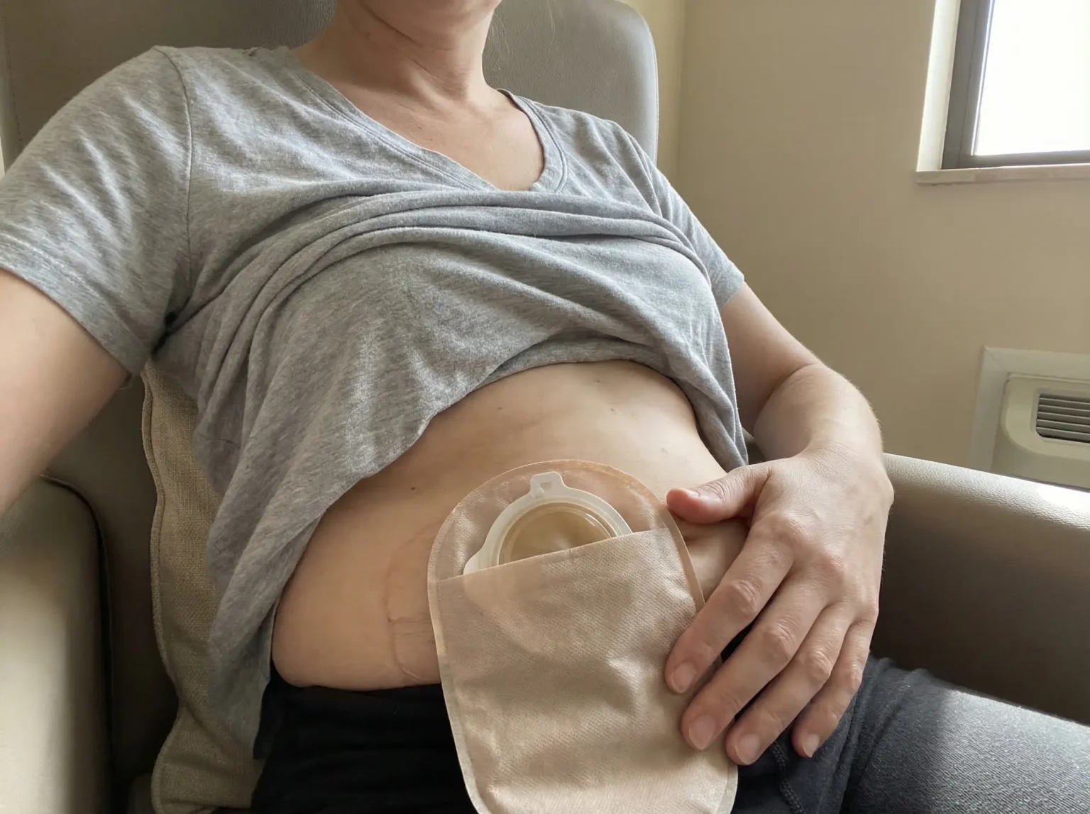 Jak żyć ze stomią